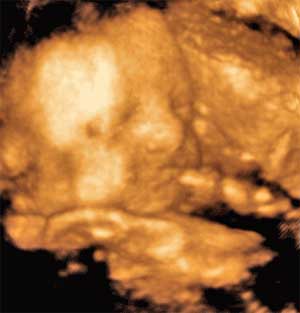 ultrasound picture