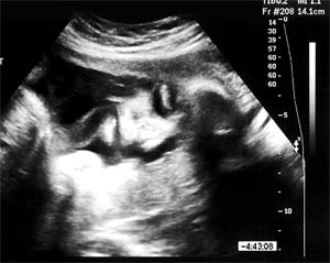 prenatal ultrasounds